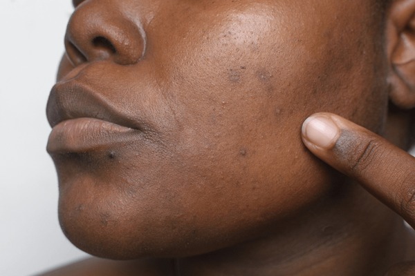 How to Remove Isichitho Pimples